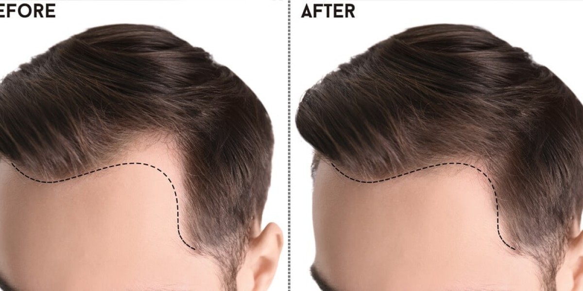 Comprehensive Guide to Hair Transplant in Islamabad