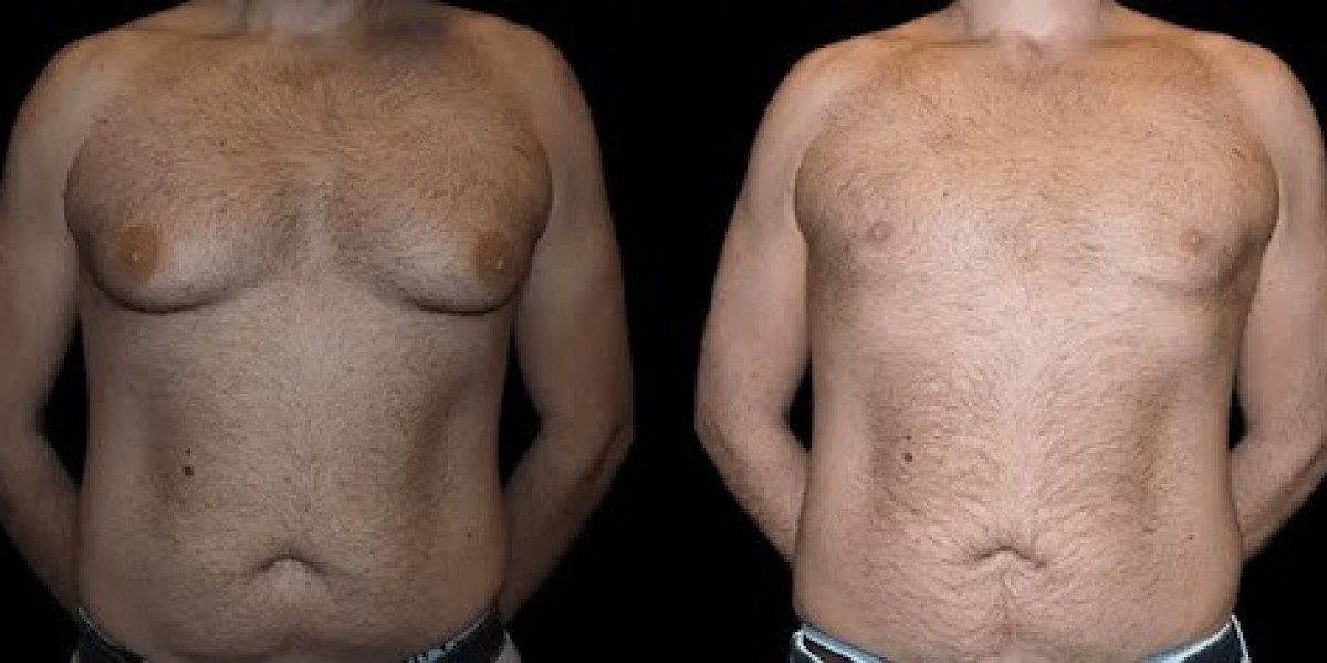 Exploring the Role of Hormones in Male Breast Reduction Outcomes