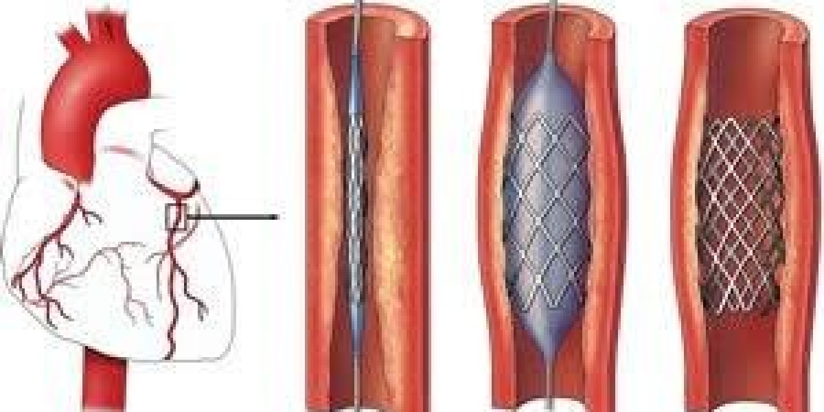 Carotid Angiography in Jaipur: A Vital Diagnostic Tool