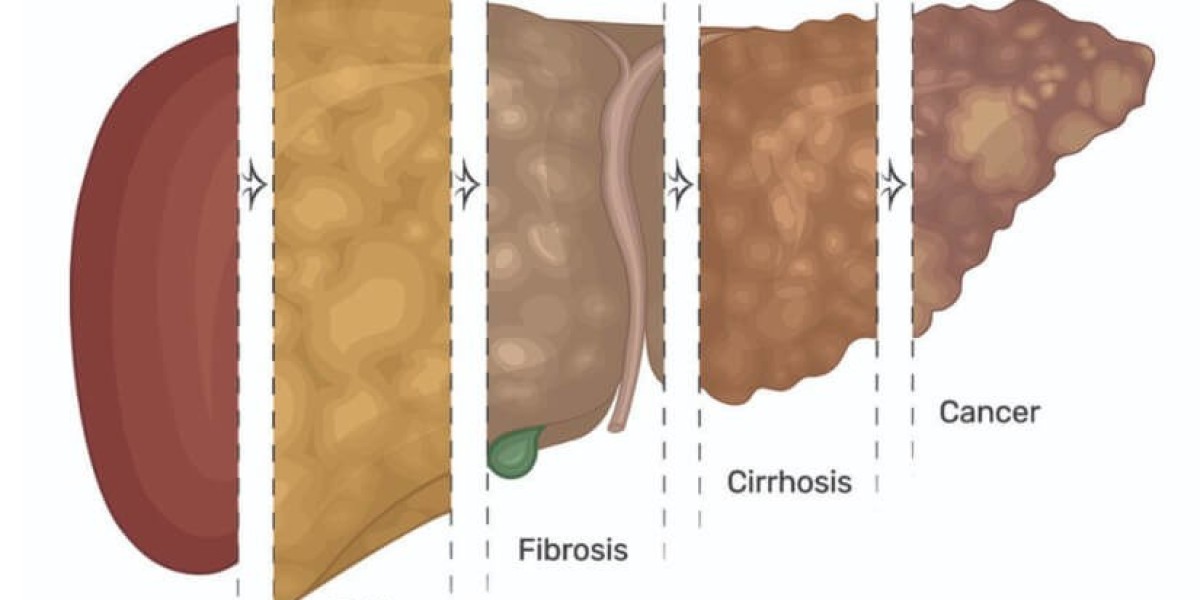 Fatty Liver Test in Jaipur: Understanding Your Liver Health