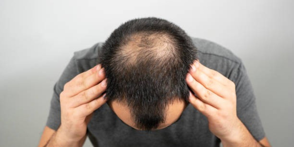 Learn everything you need to know about hair transplants in Dubai