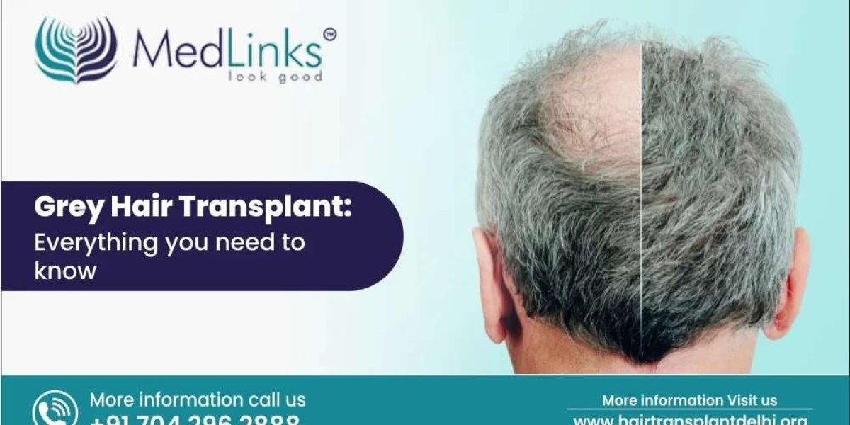 Can You Get A Hair Transplant With Grey Hair?