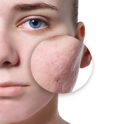 Acne Scar Treatment in Islamabad Pakistan - ERCs